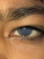 Mucopolysaccharidosis. Corneal deposit disease.