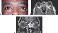 Ethmoid sinus squamous cell carcinoma. A, Photograph shows fullness of the medial canthal area overlying the mass. Axial (B) and coronal (C)