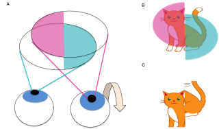 Figure 5 A) Visual field of both eyes with bitemporal hemianopia and hypertropia of right eye (left eye visual field indicated in blue, right eye visual field indicated in pink). Note the upward deviation of the right eye. B) Visual fields of an object (cat) at the point of fixation. The visual field of the right eye is shifted upwards so the corresponding half of the object is perceived to be in a different location in space vertically compared to the half seen by the left eye. C) Image seen by the patient with binocular vision. The left half of the object (perceived by the intact temporal field of the right eye) is displaced downwards compared to the right half of the object (perceived by the intact temporal field of the left eye).