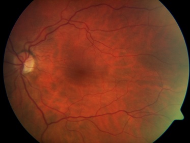 Fundus Photo demonstrating horizontal chorioretinal folds