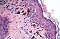 Photomicrograph demonstrating polygonal dendritic melano-cytes arranged in solitary units along the basal layer of the epidermis (stain,hematoxylin– eosin; original magnification, x100).