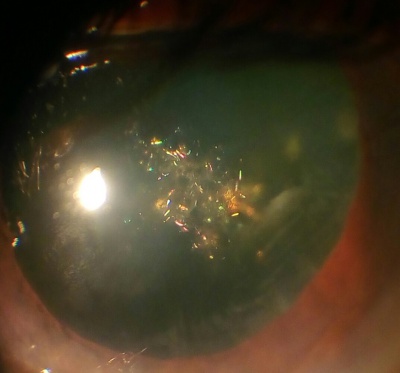 Christmas tree cataract