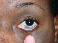 The slate-gray pigmentation involving the sclera and periorbital area is characteristic of oculodermal melanocytosis (nevus of Ota). Oculodermal melanocytosis is associated with an increased risk of pigmented tumors, such as choroidal melanoma.