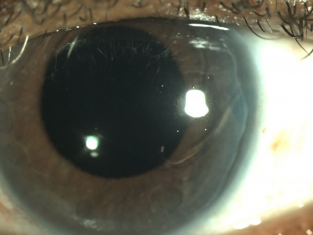 uveitis glaucoma hyphema syndrome icd 10