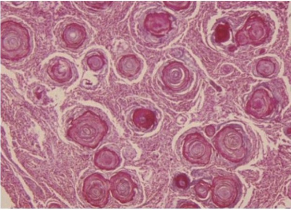 FIGURE 2: Localized Psammomatous Sphenoid Wing Meningioma stained with H&E (20x). Image demonstrates diffuse psammoma- calcifications often found at the center of the meningothelial whorls.