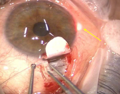 Figure 11: Passage of microcatheter into Schlemm's Canal