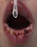 Clinical photo of patient with prominent oral mucositis including superficial erosions and ulcerations.