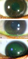 Keratopathy: various degrees of severity. A, Mild keratopathy. B, Moderate keratopathy. C, Severe keratopathy.