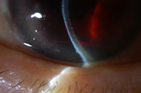 Figure 4. Slit-beam photo with hyphema visible within the inferior anterior chamber. (Same eye as Figure 3)