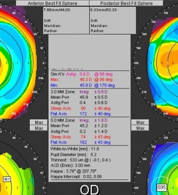 Normal orbscan statistics box GPrakash.jpg