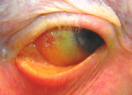 Conjunctival Amyloid.JPG