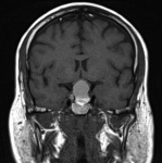 T1 Coronal MRI