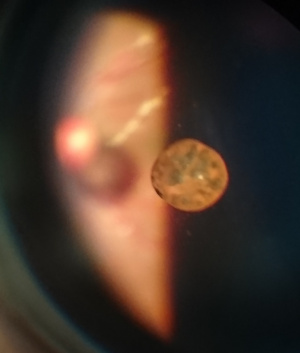 Vitreous Cyst.JPEG