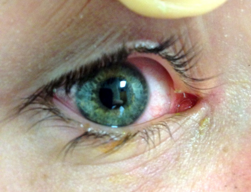 Canalicular Laceration (Trauma) - EyeWiki