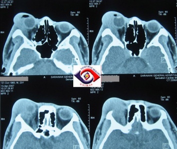 Figure 2: Diffusely enlarged right lacrimal gland with blurring of gland margin. Courtesy of Professor M Chua