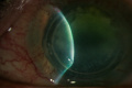 Slit-lamp examination in a patient with Acanthamoeba keratitis showing a large central infiltrate along the superior ring segment, diffuse punctate epithelial defects, fluorescein staining, stromal thinning, corneal neovascularization, and ring migration in the left eye.