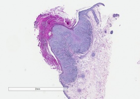 Actinic keratosis 1.7 x PAS.jpg