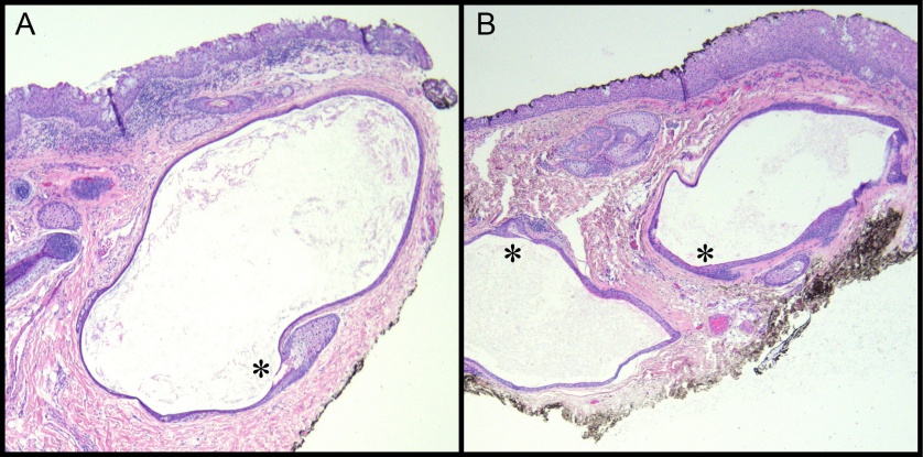 Caruncular Dermoid Cyst - Eyewiki