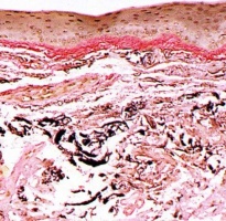 Elastic stain demonstrating subepithelial elastoic degeneration, photo courtesy of Dr.Nora Lever