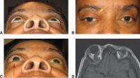 Distensible venous malformation. A, Mild proptosis resulting from venous malformation of the right orbit. B, Fullness of the right superior orbit (arrow). Note the absence of dilated corkscrew conjunctival vessels. C, After Valsalva maneuver, proptosis of the right globe increases (arrow). D, T1-weighted axial MRI shows a venous malformation of the superior ophthalmic vein.