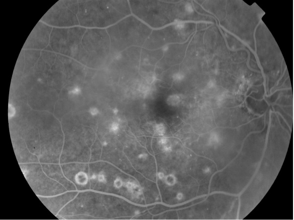 Figure 2. Fluorescein angiogram of a patient with West Nile retinopathy.