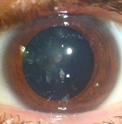 Congenital polar cataract