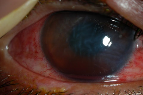 Figure 1. Slit-lamp photo illustrating conjunctival injection, corneal edema with Descemet membrane folds, and a 1 mm hyphema after blunt force trauma from an airbag deployment.