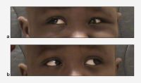 Brown syndrome. a. Child with left Brown syndrome has a hypotropia that is present with gaze up and to the right due to superior oblique restriction in the left eye. b. Eye movements and alignment are normal with gaze up and to the left.