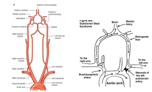 In the images above, Image 1A demonstrates the blood flow in the vertebral artery when there is no subclavian stenosis. As one can note, the flow is not impeded nor is there any pressure gradient favorability. On the other hand, Image 1B demonstrates the blood flow in the vertebral artery when there is subclavian stenosis. From the image provided, the blood flow is affected. This results in retrograde blood flow in the vertebral artery or internal thoracic artery, which is due to proximal stenosis/occlusion of the subclavian artery.