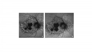 Fundus autofluorescence images of a pentosan polysulfate maculopathy patient with progressive atrophy at four (A) and eighteen (B) months after pentosan polysulfate cessation.